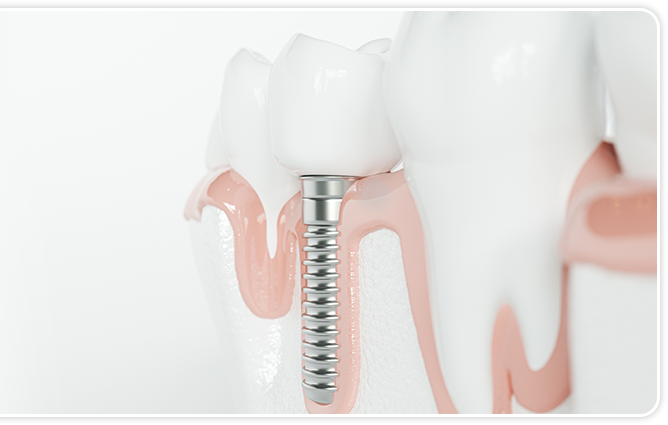自分の歯のようにしっかりと噛めて、見た目も自然。健康な歯を傷める必要がありません。
