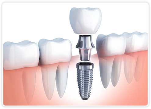 インプラントの構造